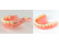 دندان مصنوعی با کیفیت - عصب کشی دندان