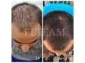 درمان تضمین شده جلوگیری از ریزش مو و رویش مجدد مو