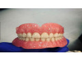 ساخت انواع دندان مصنوعی  - دندان مصنوعی ارزان