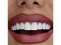 کامپوزیت و لمینت دندان در دندانپزشکی مهرنیکان کرج