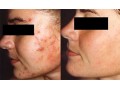 درمان  جوش صورت،جوش پوست و بدن - درمان در اب