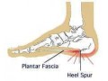 درمان قطعی خار پاشنه (Heel Spur) - کفش پاشنه بلند زنانه