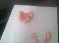 دندان مصنوعی منطقه 4