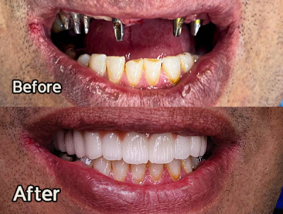 ایمپلنت ارزان در شهر تهران 