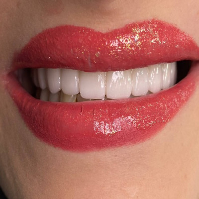 ایمپلنت اقساط در کلینیک دندانپزشکی میلان