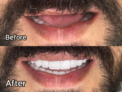 ایمپلنت ارزان در تهران - دندانپزشکی میلان 