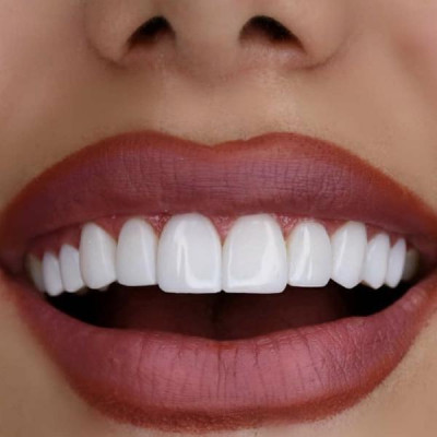 کامپوزیت و لمینت دندان در دندانپزشکی مهرنیکان کرج