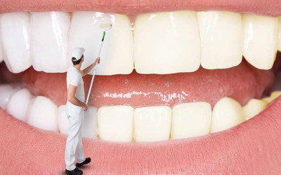 سفید کردن دندان ها