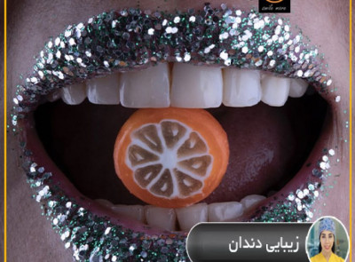 لمینیت دندان در شرق تهران