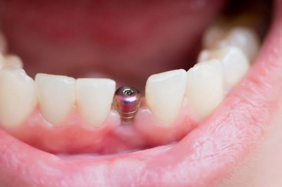 ایمپلنت دندان در کرج