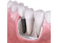 بهترین ایمپلنت - ایمپلنت دندان پزشکی