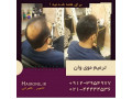نصب پروتز مو به روش بریدینگ - پروتز متحرک در مشهد
