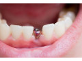 ایمپلنت دندان در کرج - ایمپلنت چیست