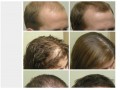 اسپری پودر پر پشت کننده فوری مو - اسپری آبرسان پوست