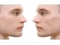از بین بردن جای جوش و زحم های پوستی و لیفت صورت با لیزر ایتالیایی co2 rf fractional در کلینیک آریس جردن