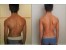 اصلاح انحرافات ستون فقرات بدون جراحی